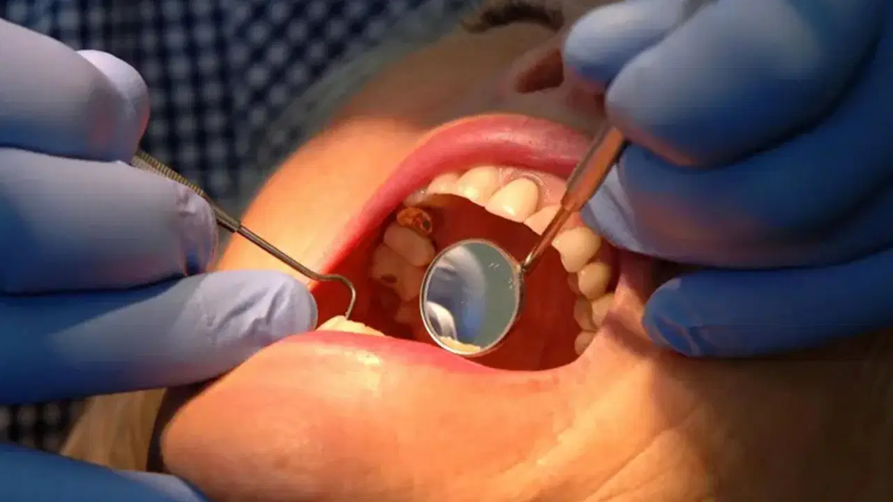 dis minesini onaran yeni jel curuklerin sonu mu geliyor 1OVsaZbn.jpg